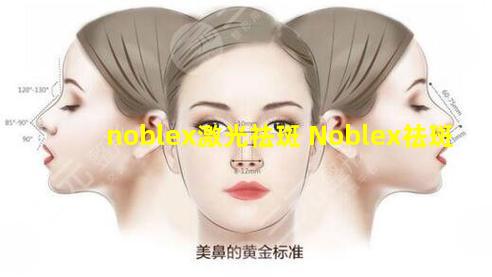 noblex激光祛斑 Noblex祛斑
